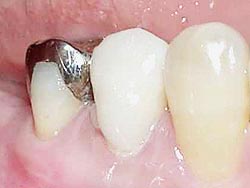 �I�t�B�X�z���C�g�j���O-�p��